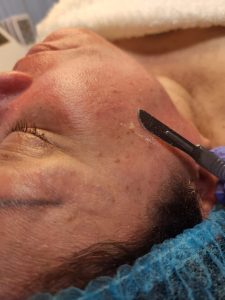 Dermaplening